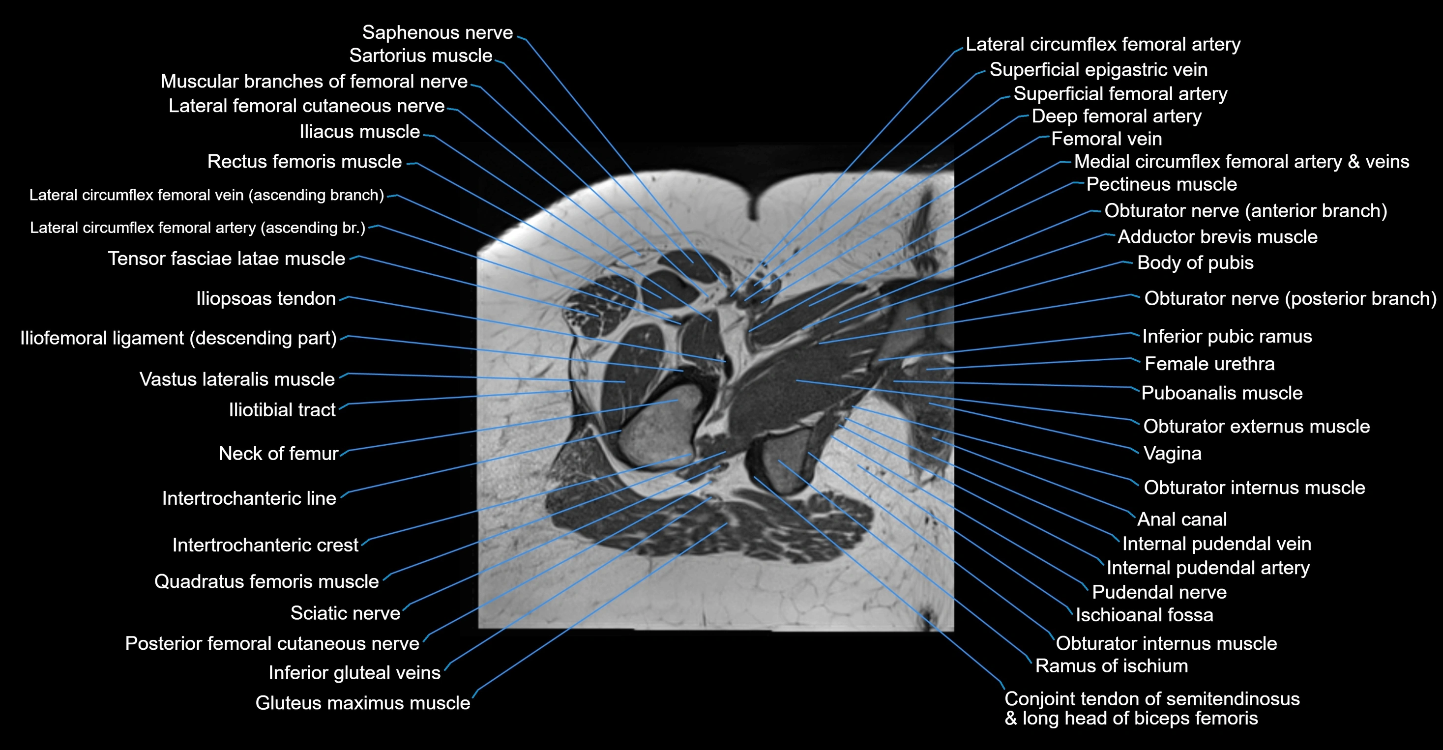 MRI hip axial cross sectional anatomy 3T 3D  radiology  anatomy image-img-00001-00057.webp